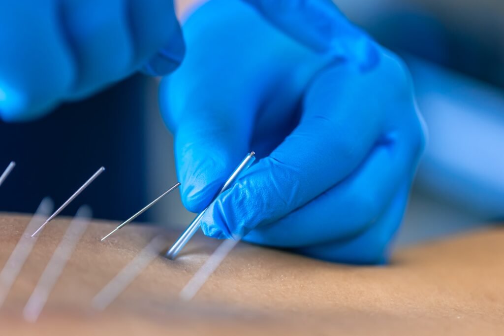 Close up of a needle and hands of physiotherapist doing a dry needling.